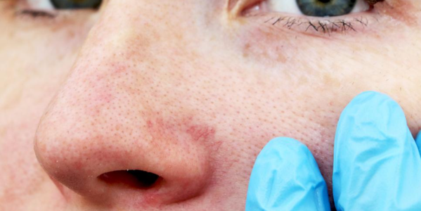  FUNCION BARRERA Y FRIO. CUIDADO DE LA PIEL  EN INVIERNO.